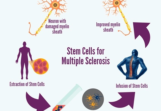 Multiple sclerosis (MS) is a relentless condition, affecting over 2.8 million people worldwide, according to the Multiple Sclerosis International Federation's 2020 data. It’s a disease where the immune system mistakenly attacks the protective myelin sheath around nerve fibers, disrupting communication between the brain and body. This leads to symptoms like fatigue, mobility issues, and cognitive decline, often with unpredictable flare-ups. Traditional treatments, such as immunosuppressive drugs and physical therapy, manage symptoms but don’t reverse damage. Enter stem cell therapy—a groundbreaking approach that’s sparking hope by potentially repairing the nervous system itself. This blog dives into the science, progress, and promise of stem cell treatments for MS, grounded in the latest research and real-world outcomes. The Science Behind Stem Cells Stem cells are the body’s raw materials, capable of transforming into specialized cells like neurons or immune cells. Their unique ability to self-renew and differentiate makes them a powerful tool for regenerative medicine. In MS, two types of stem cells are primarily explored: hematopoietic stem cells (HSCs) and mesenchymal stem cells (MSCs). HSCs, found in bone marrow, can reboot the immune system, while MSCs, sourced from tissues like fat or umbilical cords, have anti-inflammatory and neuroprotective properties. Research published in The Lancet Neurology (2021) highlights how these cells can modulate immune responses and potentially repair myelin, addressing the root causes of MS rather than just its symptoms. Rewriting the Immune System One of the most promising stem cell treatments for MS is autologous hematopoietic stem cell transplantation (aHSCT). This involves harvesting a patient’s HSCs, wiping out their faulty immune system with chemotherapy, and then reinfusing the stem cells to rebuild a healthier one. A 2022 meta-analysis in Neurology reviewed 15 studies involving 764 MS patients and found that 75% of those treated with aHSCT showed no disease progression five years post-treatment. Moreover, 61% experienced improved disability scores, a rare outcome with conventional therapies. The procedure isn’t without risks—chemotherapy can cause infections or infertility—but its potential to halt aggressive, relapsing-remitting MS has made it a game-changer for some. Mesenchymal Magic: Healing from Within MSCs offer a less invasive alternative, leveraging their ability to reduce inflammation and promote tissue repair. Unlike aHSCT, MSC therapy doesn’t require immune system ablation, making it safer for some patients. A 2023 phase II clinical trial reported in Stem Cells Translational Medicine involved 54 patients with progressive MS who received MSC infusions derived from umbilical cord tissue. After one year, 58% showed stabilized or improved neurological function, with MRI scans indicating reduced lesion activity in 42% of participants. MSCs work by secreting factors that calm overactive immune cells and encourage myelin regeneration, offering a dual-action approach that’s both protective and reparative. The Global Push for Progress Clinical trials are accelerating worldwide, with over 200 studies listed on ClinicalTrials.gov as of 2025 exploring stem cells for MS. Europe leads the charge, with centers in the UK and Italy reporting promising outcomes. For instance, a 2024 study from the University of Cambridge followed 100 patients undergoing aHSCT; 80% remained relapse-free after three years, and 65% showed sustained improvement in motor function. In the US, the FDA has fast-tracked MSC-based therapies, with biotech firms like Celularity advancing trials for progressive MS. Meanwhile, countries like India and China are emerging as hubs for affordable stem cell treatments, though regulatory oversight varies, raising concerns about unproven clinics. Challenges on the Horizon Despite its promise, stem cell therapy faces hurdles. Cost is a major barrier—aHSCT can exceed $150,000 in the US, and MSC treatments, while cheaper, often aren’t covered by insurance. Side effects, like infections or graft failure in aHSCT, pose risks, particularly for older patients or those with comorbidities. Long-term data is also limited; most studies track outcomes for five years or less, leaving questions about durability. Ethical concerns linger, too, especially around embryonic stem cells, though most MS research uses adult or umbilical cord-derived cells to sidestep these issues. Regulatory bodies like the FDA and EMA are tightening standards to ensure safety, which may delay widespread access. Real Stories, Real Impact Beyond the numbers, patient stories illuminate the human side of stem cell therapy. Take Sarah, a 34-year-old from London diagnosed with relapsing-remitting MS in 2017. After years of worsening symptoms, she underwent aHSCT in 2022. “I went from needing a cane to jogging again,” she shared in a BBC interview. “It’s not a cure, but it’s given me my life back.” Similarly, a 2024 case study in Journal of Neurology described a 45-year-old man with progressive MS who regained hand dexterity after MSC therapy, allowing him to resume painting, his lifelong passion. These stories underscore the transformative potential of stem cell treatments, even if results vary. The Future of MS Care The horizon for MS treatment is bright, with stem cell research paving the way for personalized medicine. Scientists are exploring ways to enhance stem cell efficacy, such as combining them with gene therapies to boost myelin repair. A 2025 study in Nature Neuroscience demonstrated that genetically modified MSCs in mice doubled the rate of myelin regeneration compared to standard MSCs. Other innovations include biomaterials that guide stem cells to damaged areas, improving their precision. As artificial intelligence advances, it’s being used to predict which patients will respond best to specific stem cell therapies, optimizing outcomes and reducing costs. A Balanced Perspective Stem cell therapy isn’t a magic bullet. Not every patient benefits, and some experience minimal improvement or temporary effects. The Multiple Sclerosis Journal (2023) notes that patients with advanced progressive MS are less likely to see gains compared to those with early-stage, relapsing forms. Accessibility remains a challenge, with high costs and limited availability in low-income regions. Yet, the trajectory is promising. As trials expand and technologies evolve, stem cell therapies could shift MS from a chronic, debilitating condition to one where remission or significant recovery is achievable for many. Joining the Journey For those living with MS, staying informed is key. Organizations like the National Multiple Sclerosis Society offer resources on clinical trials and treatment options. Patients considering stem cell therapy should seek reputable centers with transparent protocols and avoid unverified clinics promising miracles. Discussing risks and benefits with neurologists and researching ongoing trials can empower informed decisions. The road to a cure is still unfolding, but stem cell therapy represents a bold step forward, offering hope where once there was only management. With continued research and global collaboration, the dream of restoring lives disrupted by MS is closer than ever. Visit our website https://stemnovaclinic.com/ to know more about ms treatment with stem cells at Affordable Price.