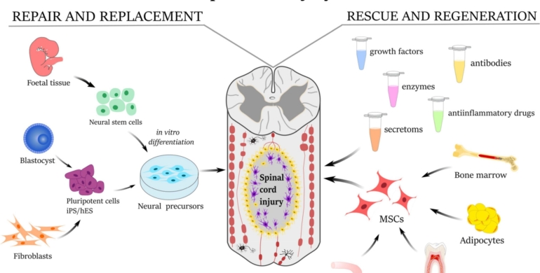 Stem Cell Therapy for Spinal Cord Injury